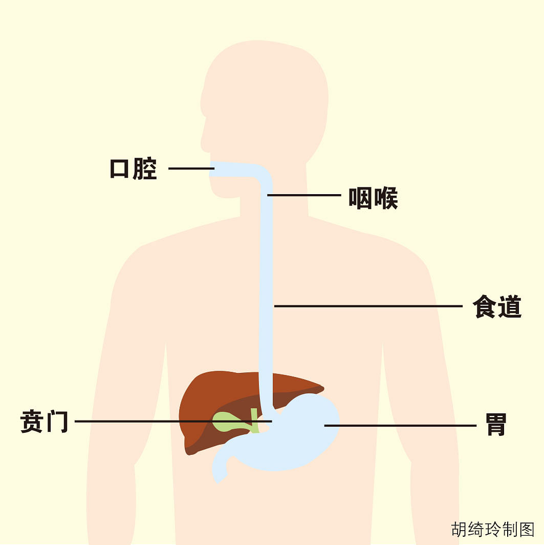 胃酸倒流 藥物舒緩 客觀分析 手術根治