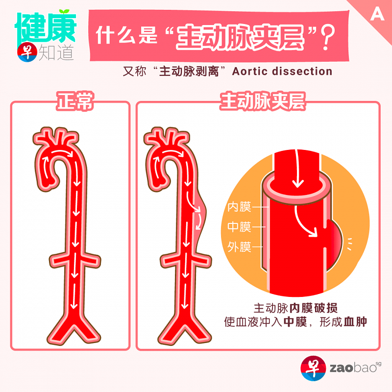 20200922_lifestyle_aortic01_Large.png