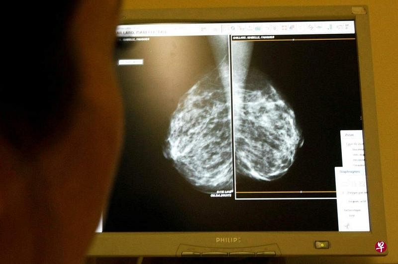 现在乳腺癌诊断技术和治疗方法都大有提升，不仅提高了乳房X光检查的准确性，更好的治疗方法也提高了患者的存活率。（路透社）