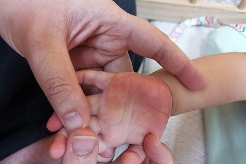 11个月大男宝宝在后院爬行后双手灼伤，母亲指托婴中心职员疏失。（取自脸书群组）
